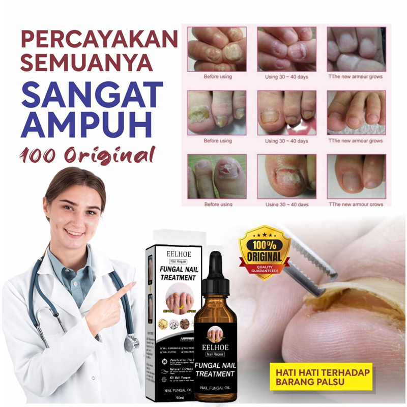 Obat Jamur Kuku Obat kuku jamur dan rusak Perawatan Kuku Berjamur Antibakteri Perawatan Kuku Onikomikosis Paronychia Anti Infeksi Kuku Toe Nail Pengobatan Jamur Minyak Nail Repair Essence Serum