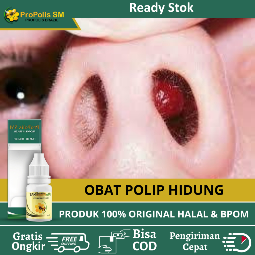Obat Tetes Polip Hidung, Obat Polip Hidung Kronis Dan Akut, Hidung Mampet, Hidung Tersumbat, Polip A