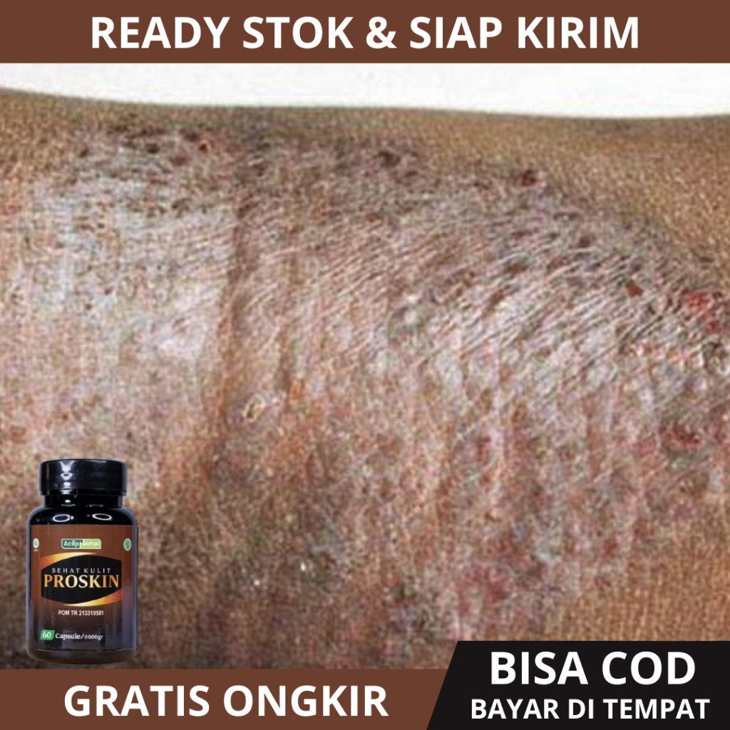 Obat Eksim Kulit Gatal Untuk Gatal Gatal, Obat Gatal Exim Kering Menahun, Exsim Dermatitis, Exsim Ba