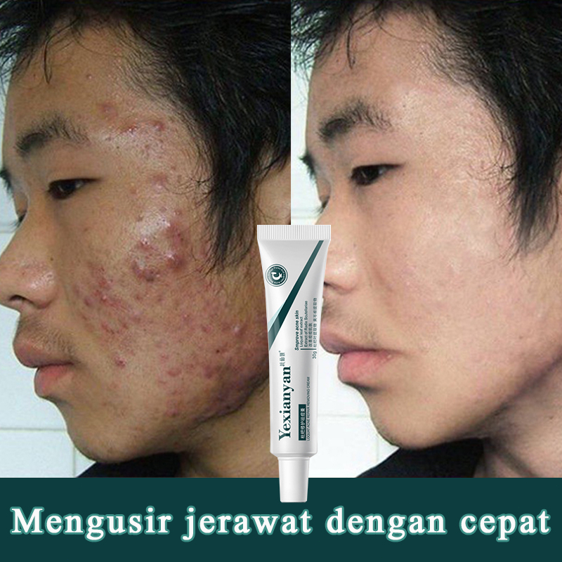 Krim menghilangkan jerawat, menghilangkan jerawat, menghilangkan bekas jerawat, jerawat pubertas, ko