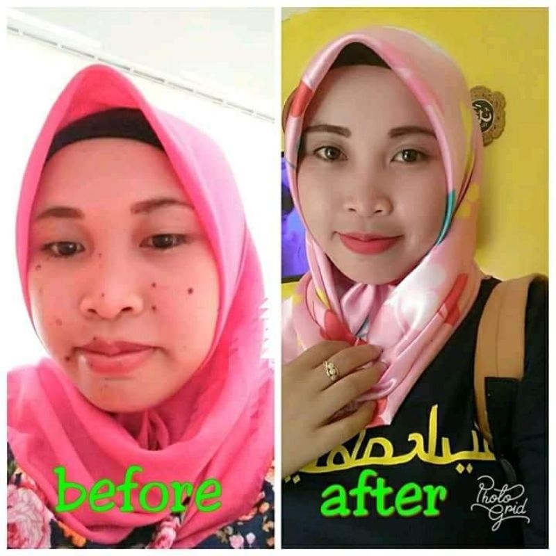 penghilang tahilalat kutil mata ikan