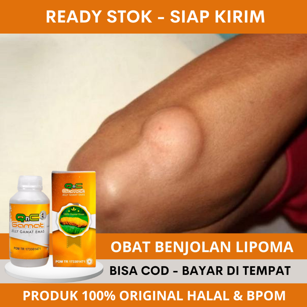 Obat Lipoma, Obat Herbal Buat Tumor Lipoma, Obat Penghancur Lipoma, Obat Oles Benjolan Lipoma, Obat 