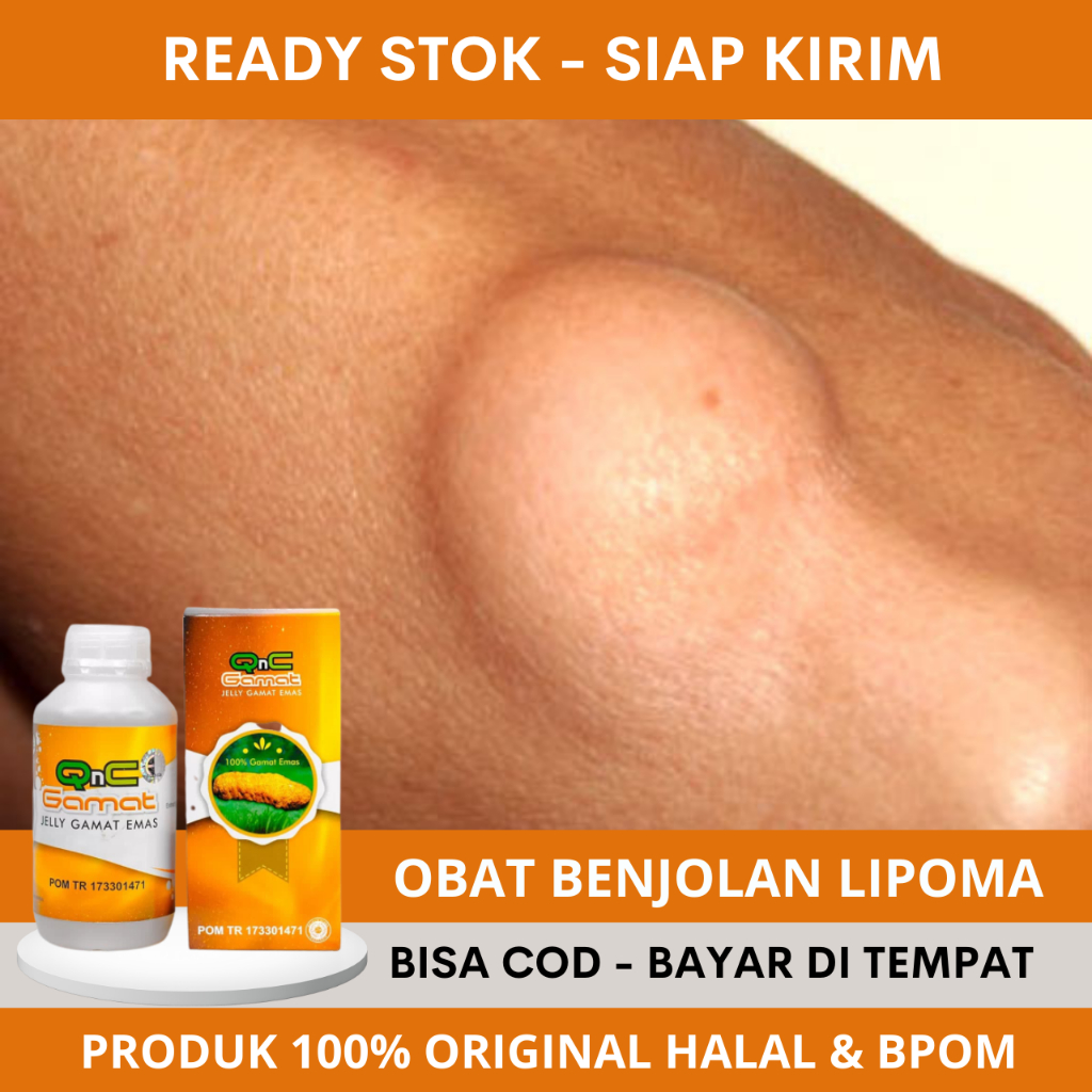 Obat Lipoma, Penghancur Benjolan Lipoma, Pengecil Benjolan Lipoma, Pengempis Benjolan Lipoma, Penghi