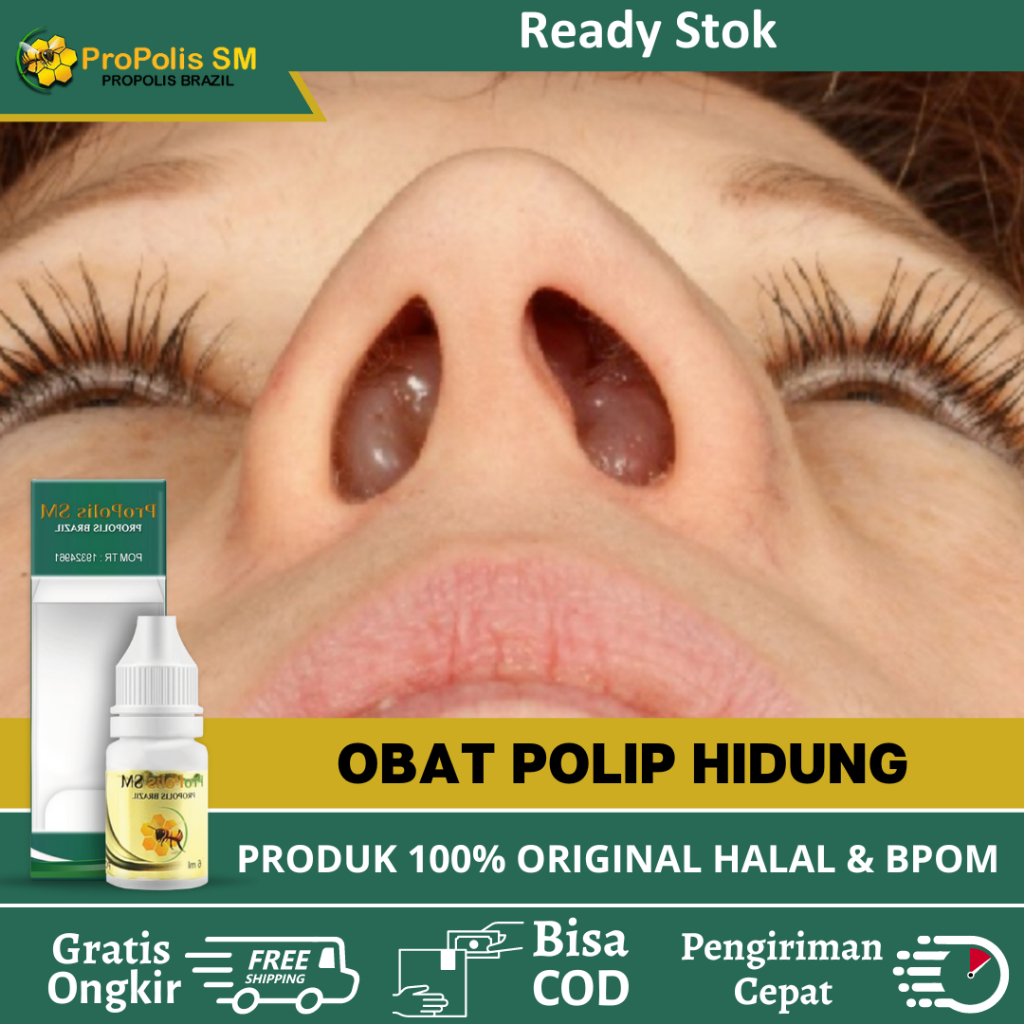 Obat Tetes Polip Hidung Pada Anak Dan Dewasa, Sunisitis, Obat Benjolan Di Hidung, Benjolan Polip, Be
