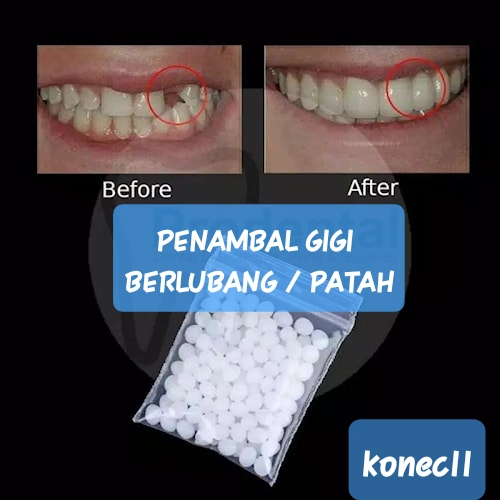Penambal Gigi 2g 100% ORIGINAL -Temptooth Gigi Palsu isi 250 butir Temporary Tooth Rep GIGI BERLUBAN