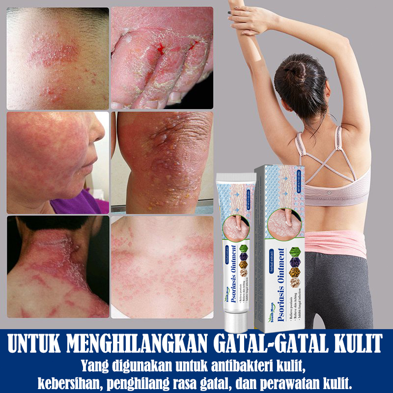 【100% ORIGINAL】[BPOM&amp;COD]Salep gatal Salep Eksim Salep kulit Krim psoriasis paling ampuh Kulit Kepala Psoriasis Tangan Tinea Kaki Bau