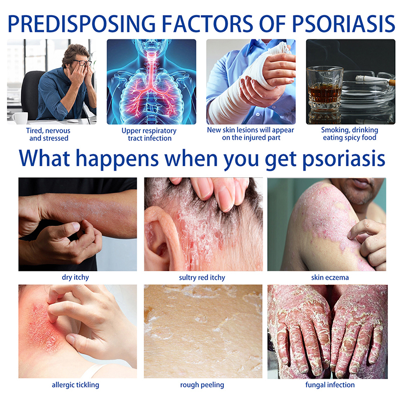 Psoriasis eksim salep gatal gatal gatal pada kulit Krim pelembap Psoriasis 30g/box perbaikan alami efektif antibakteri meringankan kulit kering gatal perawatan kulit kasar