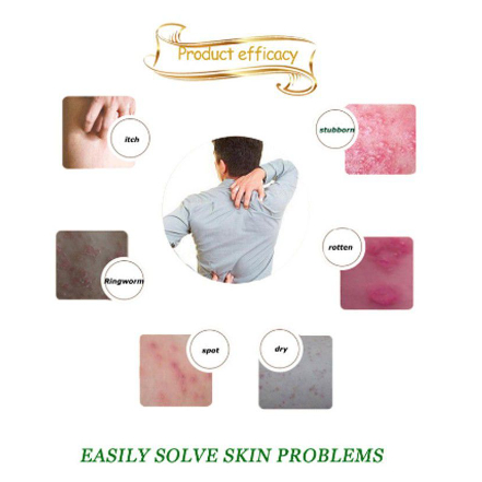 Zudaifu Salep Herbal 100% [𝐎𝐑𝐈𝐆𝐈𝐍𝐀𝐋] Salep Gatal Paling Ampuh Berkhasiat Obat Dermatitis Psoriasis Eksim Panu Jamur Kurap Kudis Alergi Kulit Selangkangan Jerawat Kutu Air Beri beri