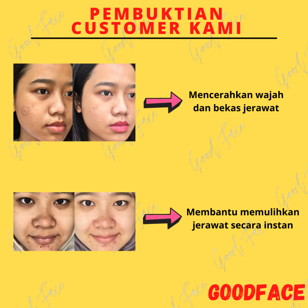 PENGHILANG JERAWAT BREYLEE Acne Cream Set Mengatasi &amp; Menghilangkan Noda Jerawat (2pcs)