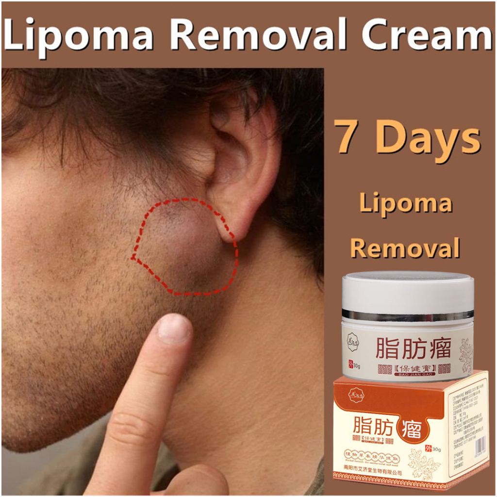 Obat Benjolan di Leher Obat benjolan Lipoma 30g Krim penghilang kista lemak (kista) Meredakan nyeri kista subkutan - Lipoma Removal Cream 100% Original