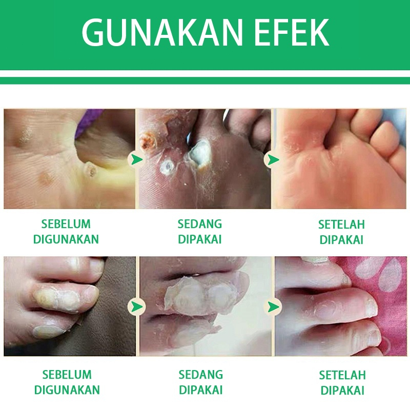 Obat Kutil Obat Kutil Kelamin 10ml Penghilang Kutil Obat Kutil Tangan Obat Kutil Wajah Obat Penghilang Kutil