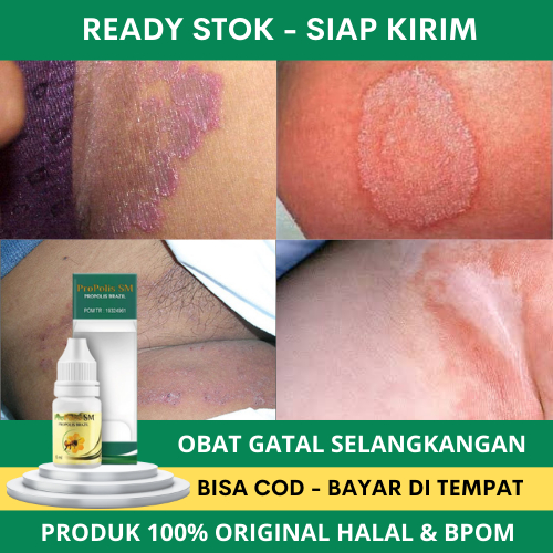 Obat Gatal Selangkangan, Obat Selangkangan Menghitam dan Gatal, Obat Infeksi Jamur Selangkangan, Oba