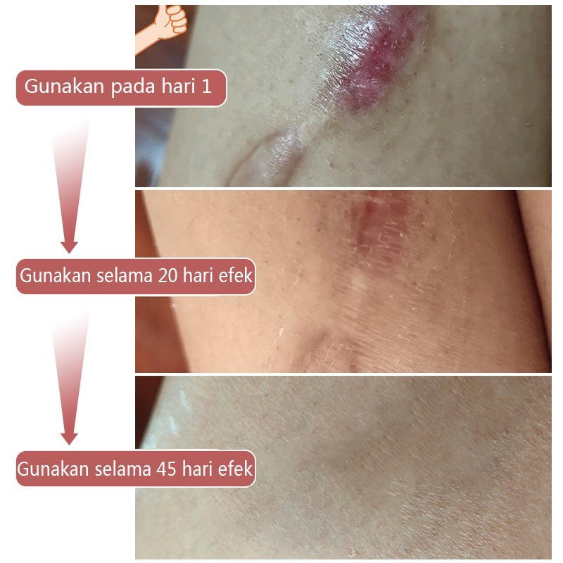 Gel menghilangkan bekas luka krim memudarkan bekas luka memperbaiki jerawat bekas luka lama bekas luka stretch mark bekas luka bakar 20g