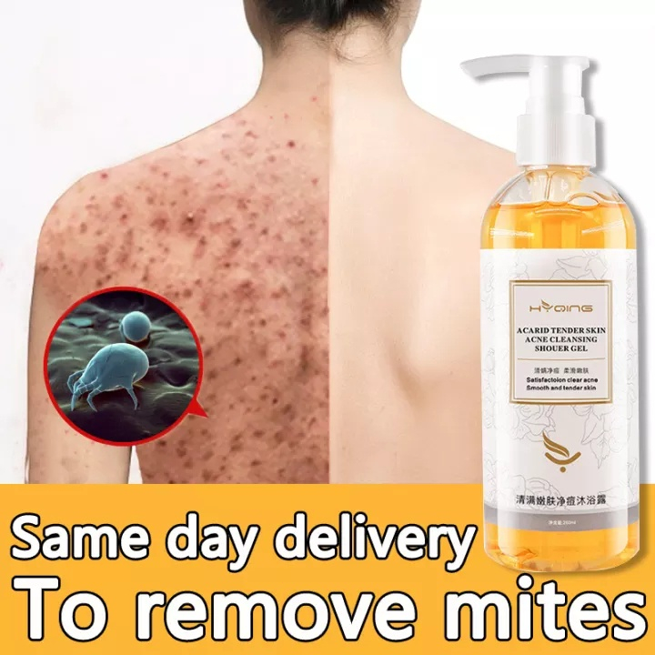 Acne Body Wash 260ml/ Whitening Body Wash / 100% herbal / Parfum Alami Shower Gel / Repair Skin / Jerawat Kulit / Gatal Antibakteri, menghilangkan tungau