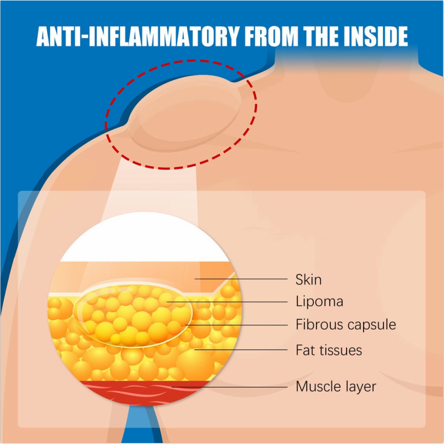 Obat Benjolan Lipoma Krim lipoma OBAT OLES PENGHILANG BENJOLAN LIPOMA 30g