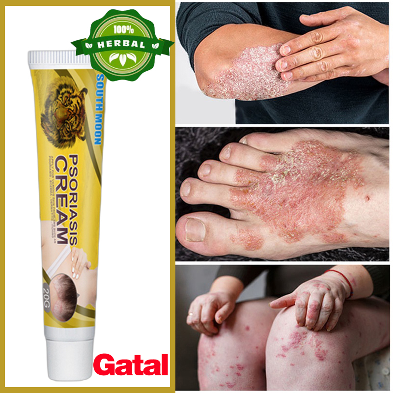 Salep gatal Salep kulit krim herbal untuk eksim psoriasis Salep gatal paling ampuh  Gatal Eksim Psoriasis Dermatitis Ecxematoid Eczema