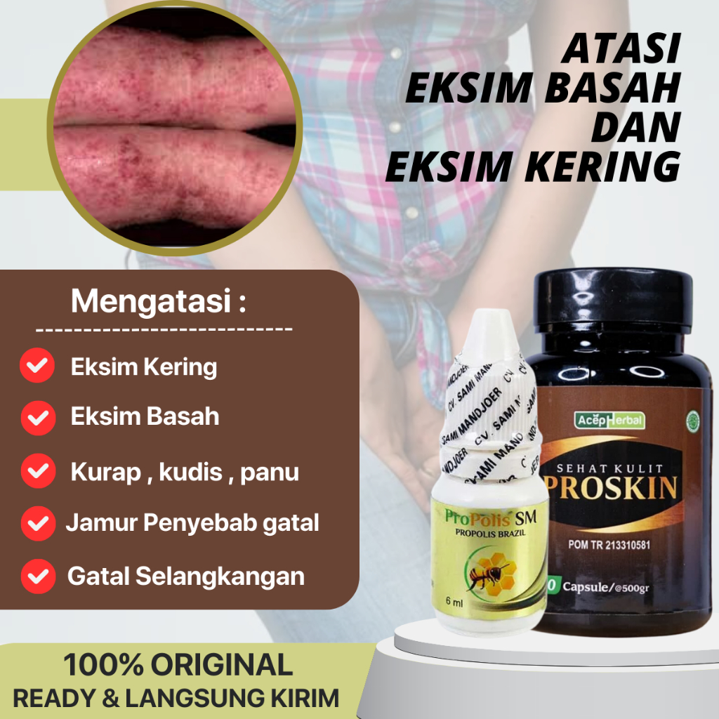 Propolis SM - Salep eksim , Salep eksim basah / eksim kering, penghilang Gatal Eksim menahun, Penghi