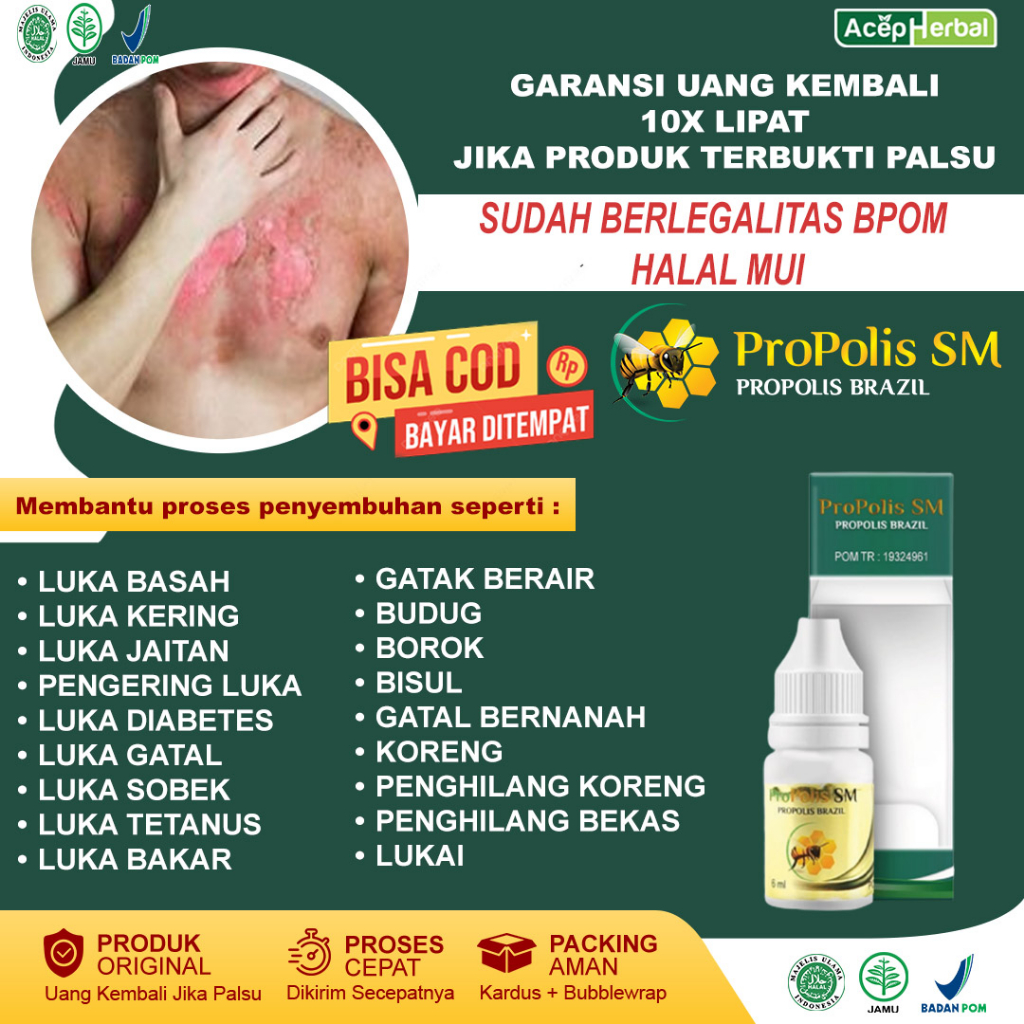 Obat Penghilang Luka Bakar Luka Bakar Menahun Obat Penghilang Luka Bakar Knalpot Luka Bakar Air Pana