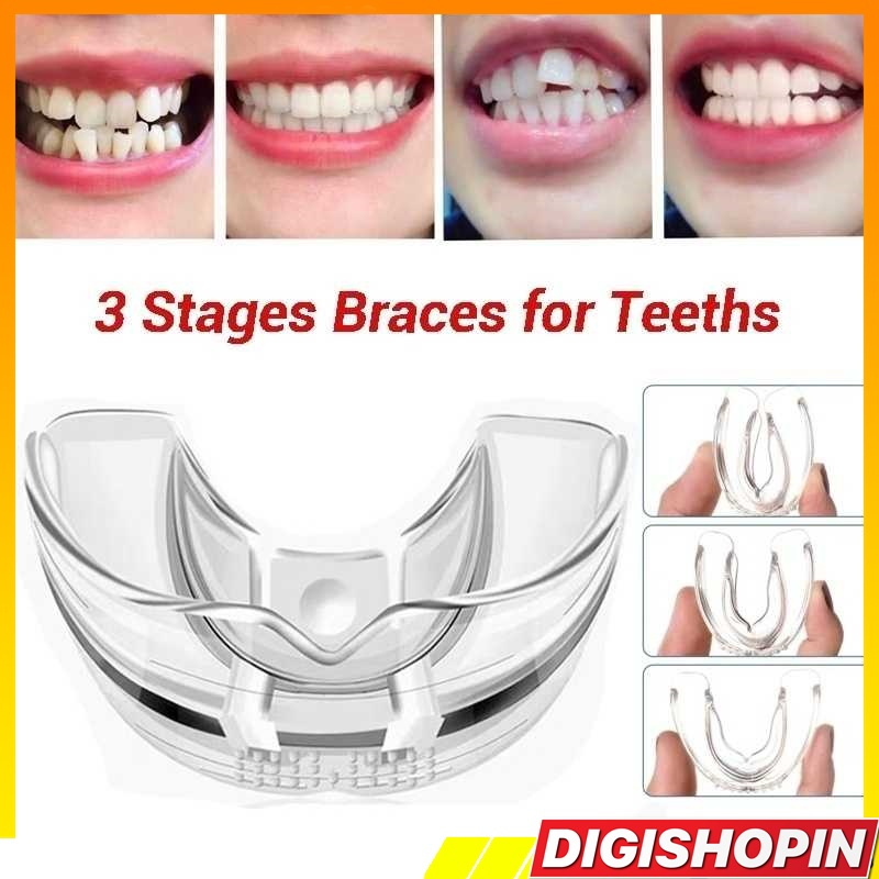 DIGISHOPIN Perawatan Gigi GIngsul Terpai Gigi Alat Perawatan Gigi Gingsul lvl3