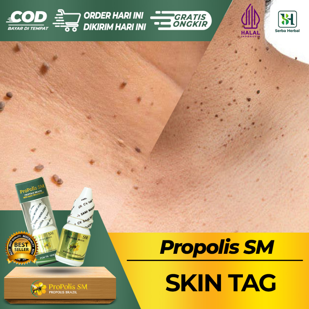 Obat skin tag di leher, skin tag di wajah, daging tumbuh, daging jadi, kutil di kelamin, benjolan ke