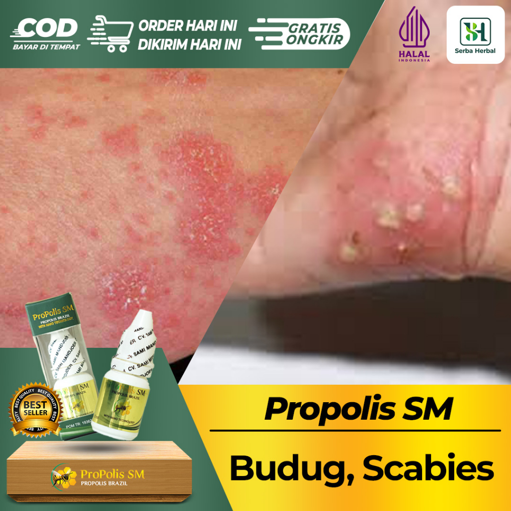 Obat Budug Atau Skabies Budug Di Kaki Budug Bernanah Budug Cenang, Budug dan Gatal Obat Tetes PROPOL