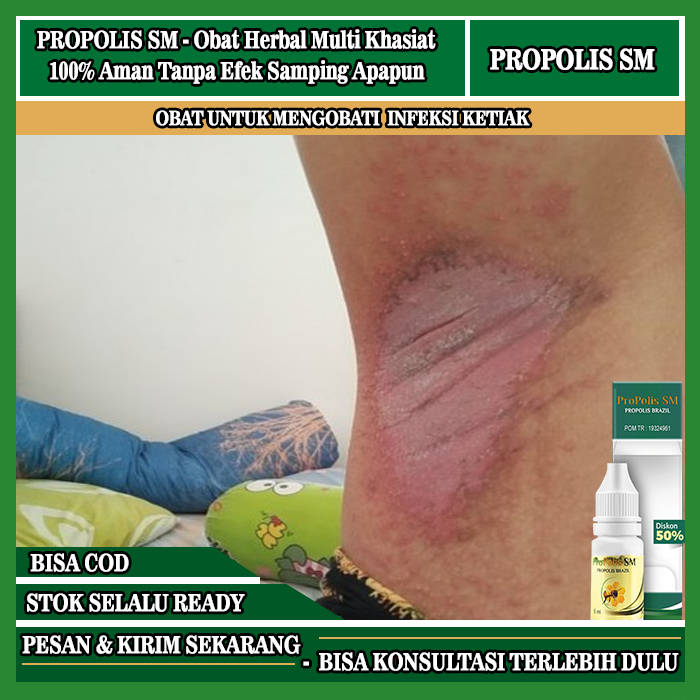 Obat Ketiak Gatal, Gatal Merah Pada Ketiak, Obat Infeksi Ketaik, Iritasi Ketiak Perih Lecet, Ruam Ga