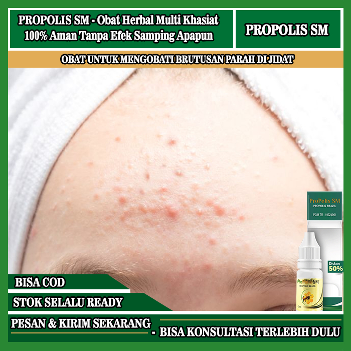 Obat Jidat Bruntusan, Obat Oles Penghilang Bruntusan Di Jidat, Menghilangkan Bruntusan Di Wajah, Oba