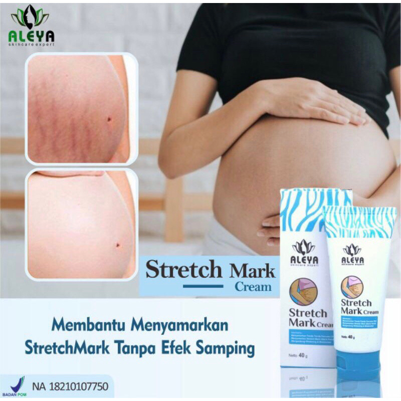 cream penghilang seloid obat penghilang strechmark obat ampuh penghilang strechmark