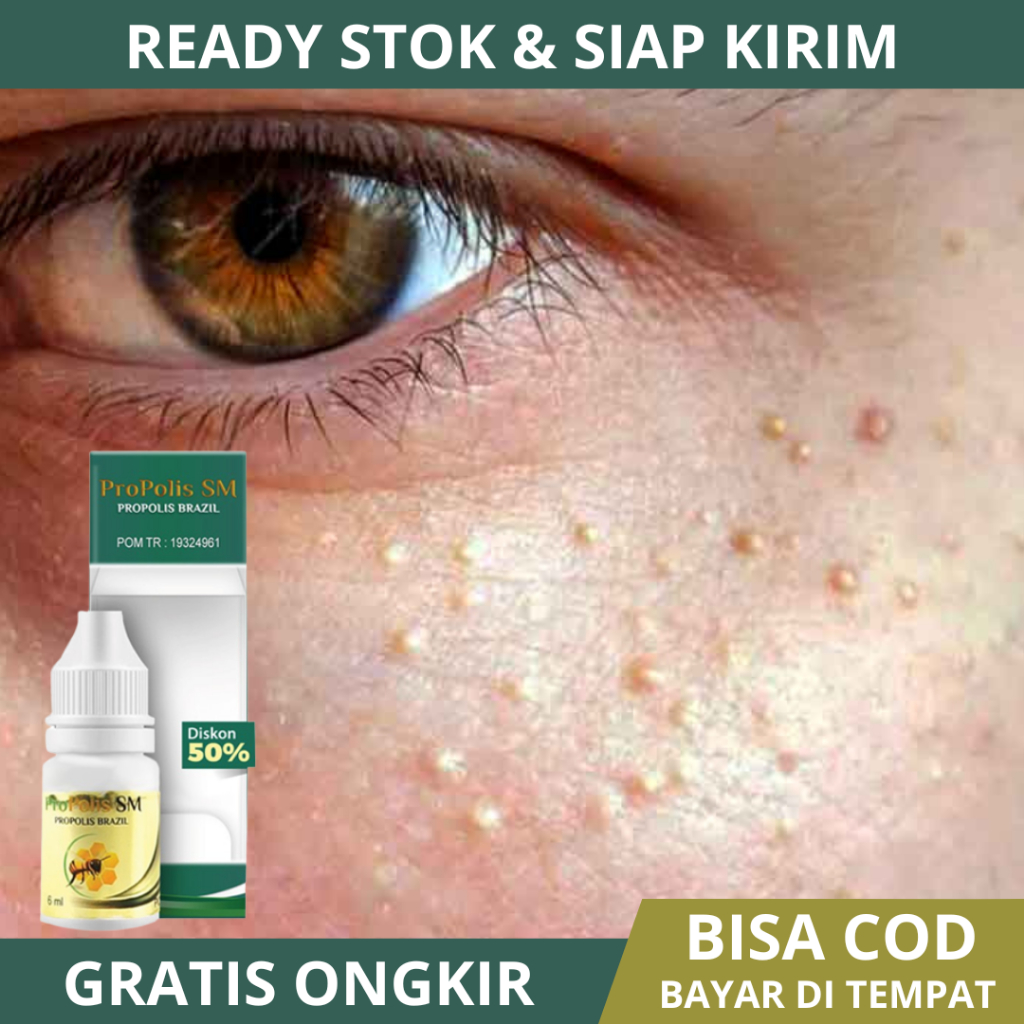 Obat Milia, Obat Milia Diarea Mata, Obat Milia Pada Wajah, Obat Milia Di Bawah Mata, Obat Milia Di K