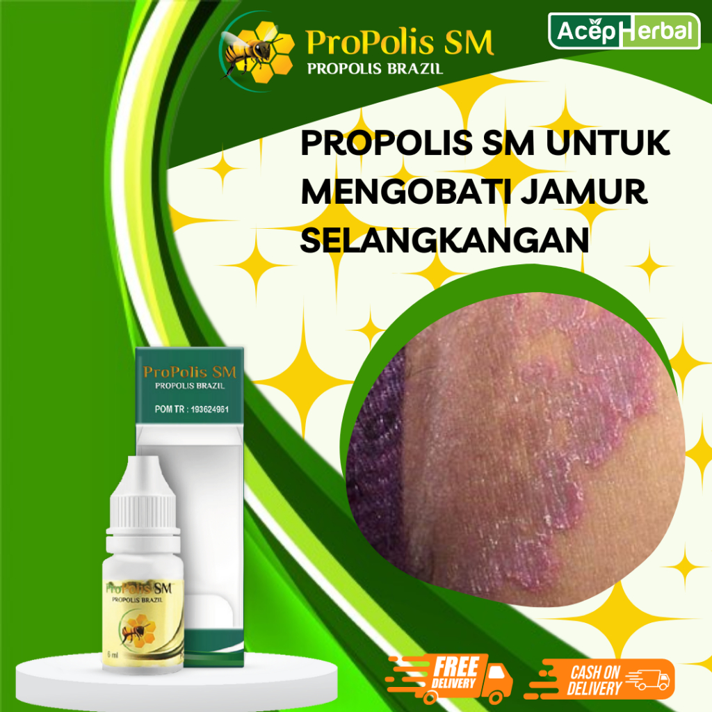 Obat Jamur Selangkangan, Kurap Selangkangan, Obat Gatal Selangkangan, Obat Luka Selangkangan, Obat B