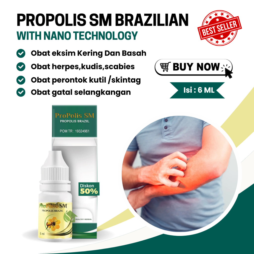 Propolis Sm Brazil Atasi Eksim Seboroik, Ketombe Parah Di Kulit Kepala Bisa COD
