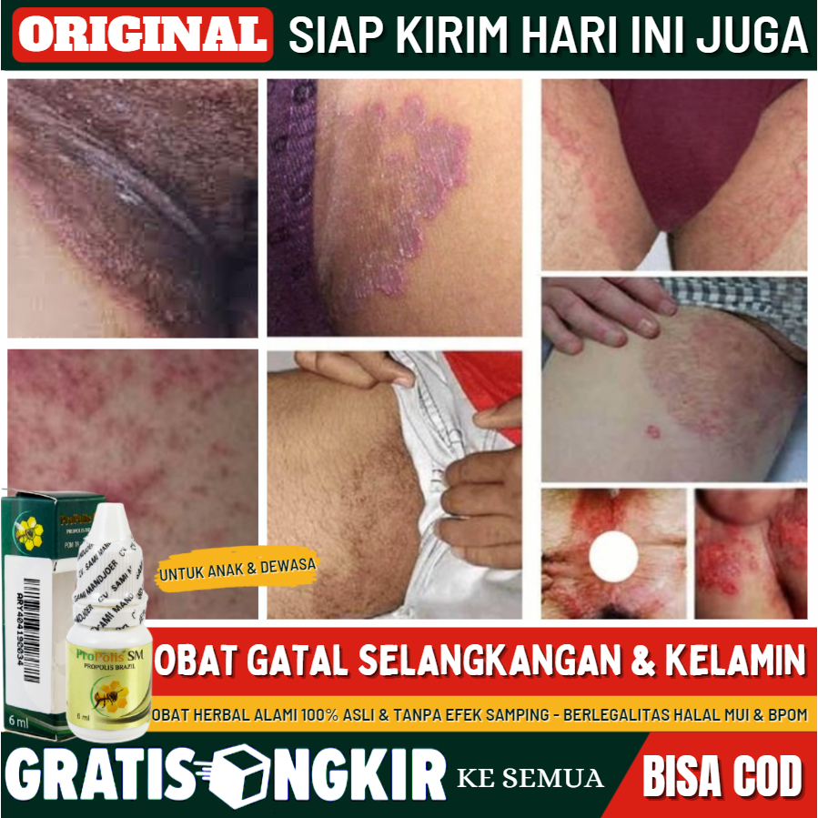 Salep Selangkangan Gatal Berjamur Kering Membekas Dan Lecet, Salep Basmi Gatal Parah, Salep Untuk Me