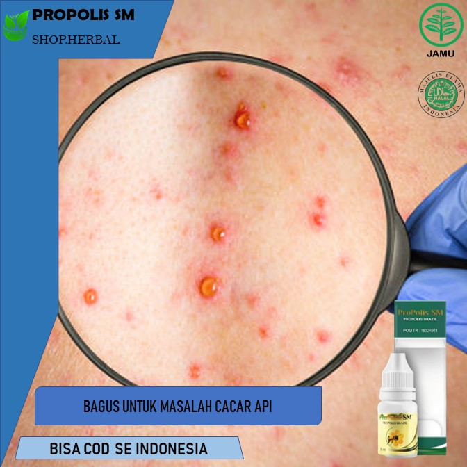 obat cacar api Obat Cacar, Obat Cacar Monyet Obat Cacar Air, Obat Penghilang Cacar, Obat Cacar Berna