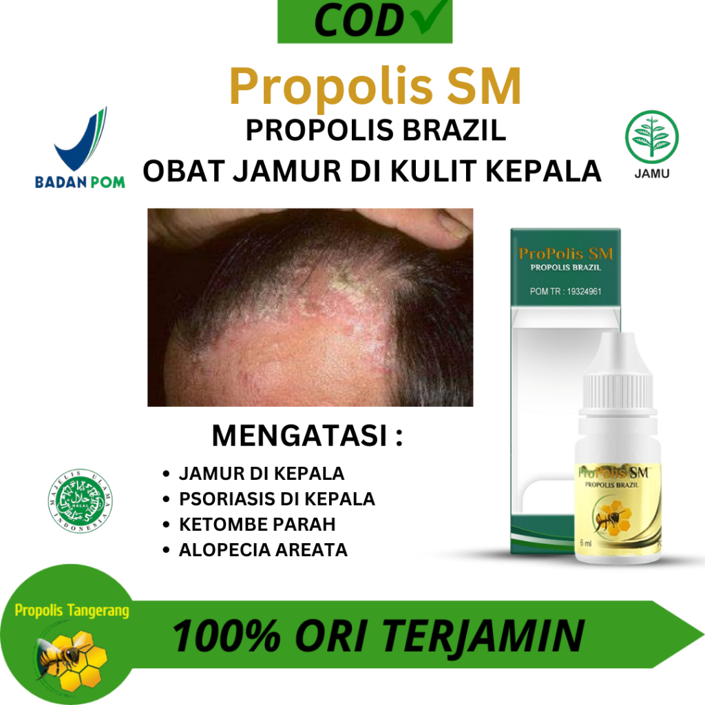 Obat Jamur Di Kepala , Obat Psoriasis Kulit Kepala , Obat Kulit Kepala Bersisik , Obat Kulit Kepala 