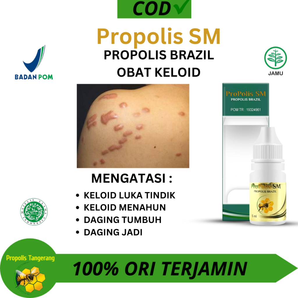 Obat Keloid , Obat Daging Tumbuh Di Leher , Obat Keloid Luka Tindik, Obat Penghilang Keloid Berkerut