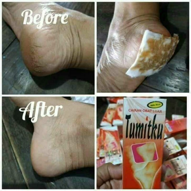 Tumitku pembersih tumit yang pecah-pecah