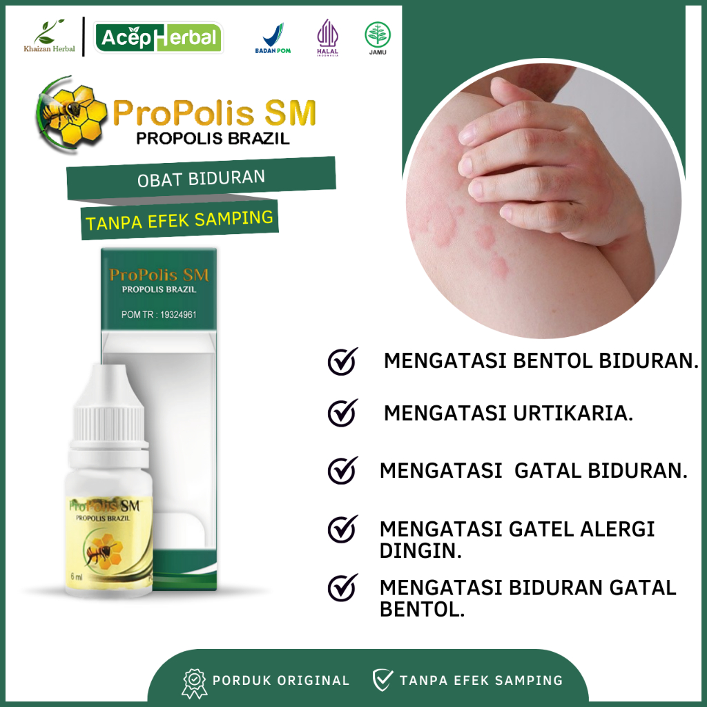 Obat Biduran - Obat Bentol Biduran, Obat Urtikaria, Obat Gatal Biduran, Obat Alergi Dingin, Obat Bid