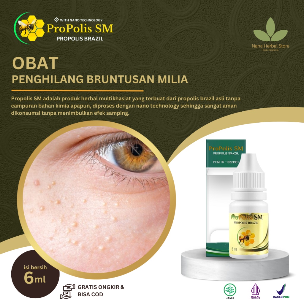 Obat Milia Di Bawah Mata, Obat Milia Di Kelopak Mata, Obat Milia Mata, Obat Milia Di Hidung, Obat Mi