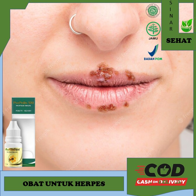 obat herpes Obat Herpes, Obat Herpes Kulit Obat Gatal Herpes - Obat Herpes - Obat Herbal Herpes - Sa