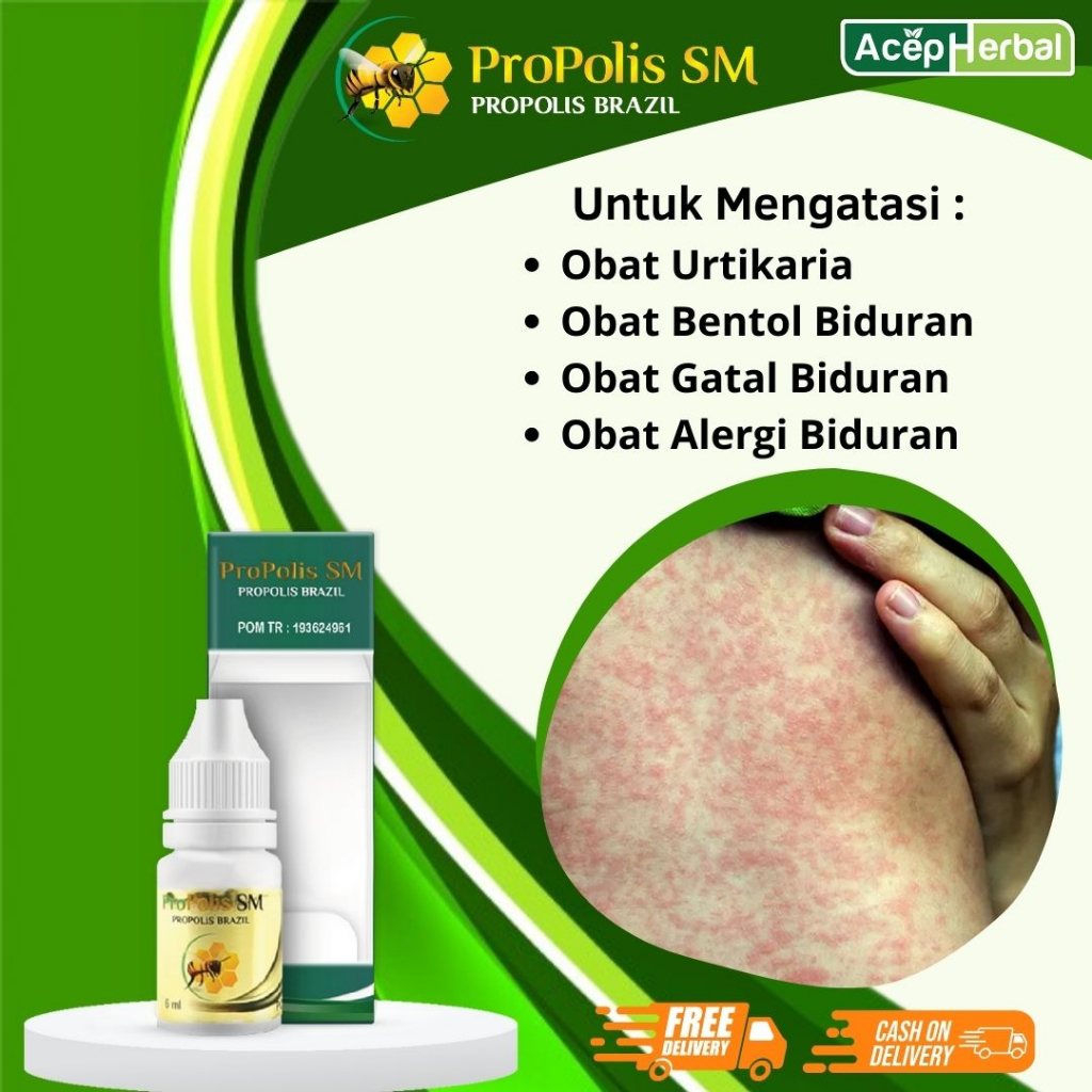 Obat Biduran - Obat Bentol Biduran, Obat Urtikaria, Obat Gatal Biduran, Obat Alergi Dingin, Obat Bid