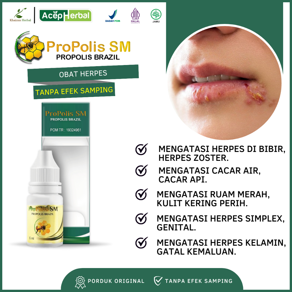 PROPOLIS SM Salep Oles Untuk Obat Herpes Atasi Obat herpes di bibir, herpes zoster, cacar air, cacar