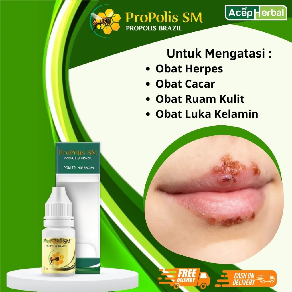 PROPOLIS SM Salep Oles Untuk Obat Herpes Atasi Obat herpes di bibir, herpes zoster, cacar air, cacar