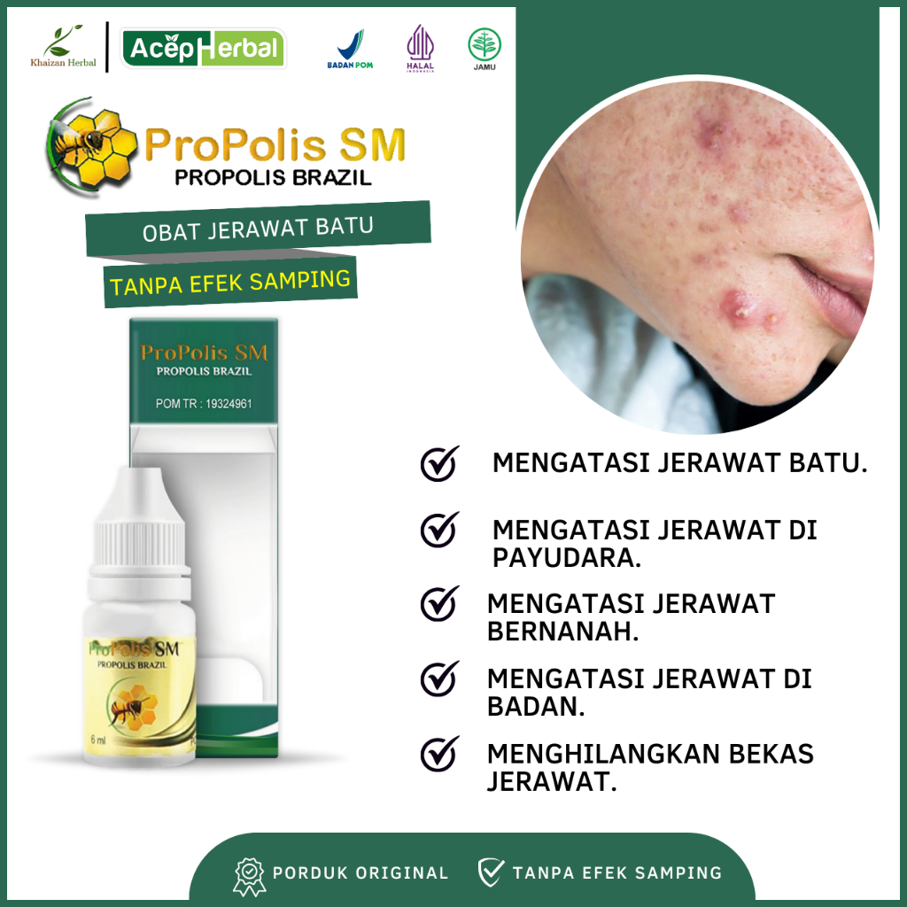 Obat Jerawat Batu - Obat Jerawat , Obat Jerawat Punggung, Obat Jerawat Di Payudara, Obat Jerawat Min