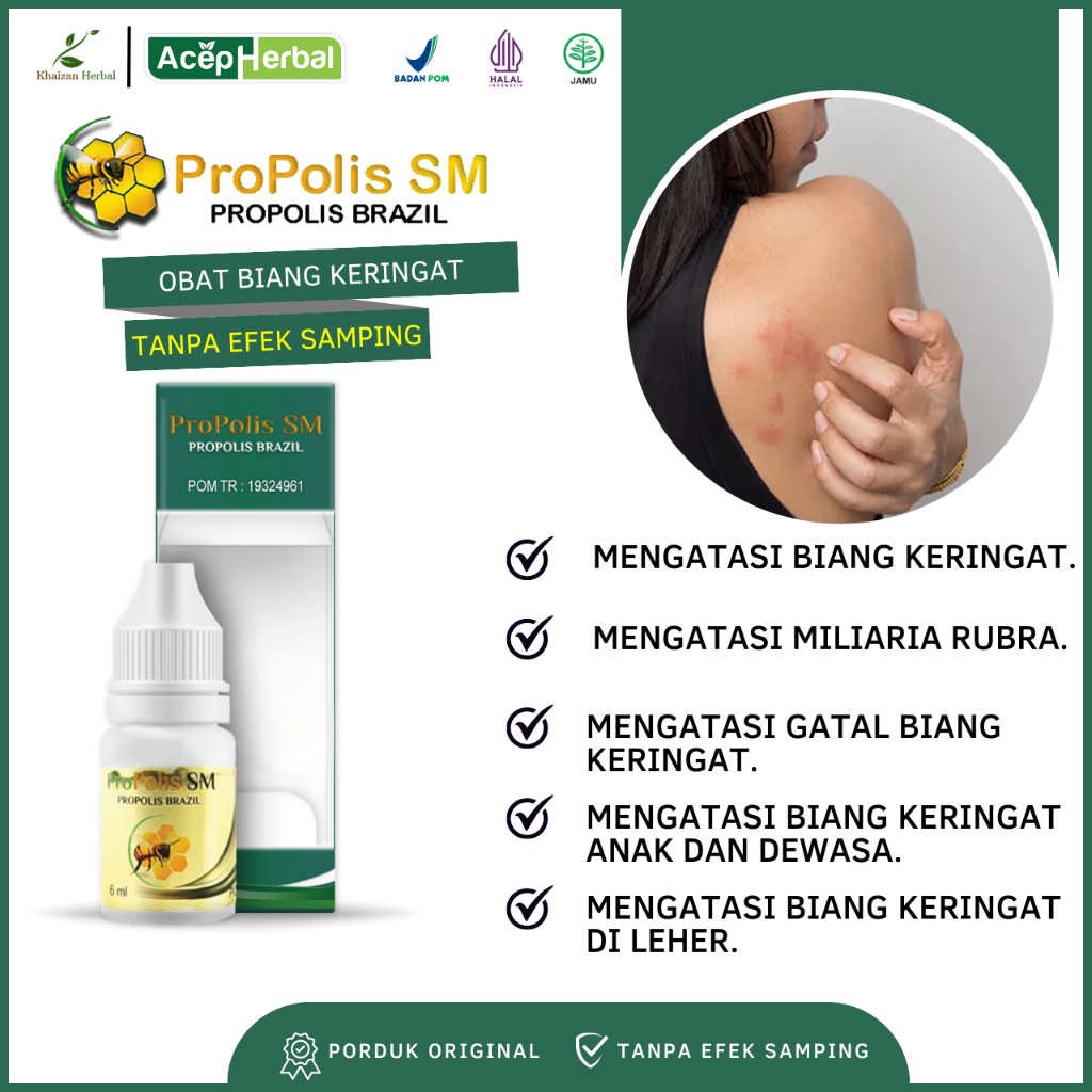 Obat Biang Keringat - Obat Miliaria Rubra, Obat Gatal Biang Keringat, Obat Biang Keringat Anak dan D