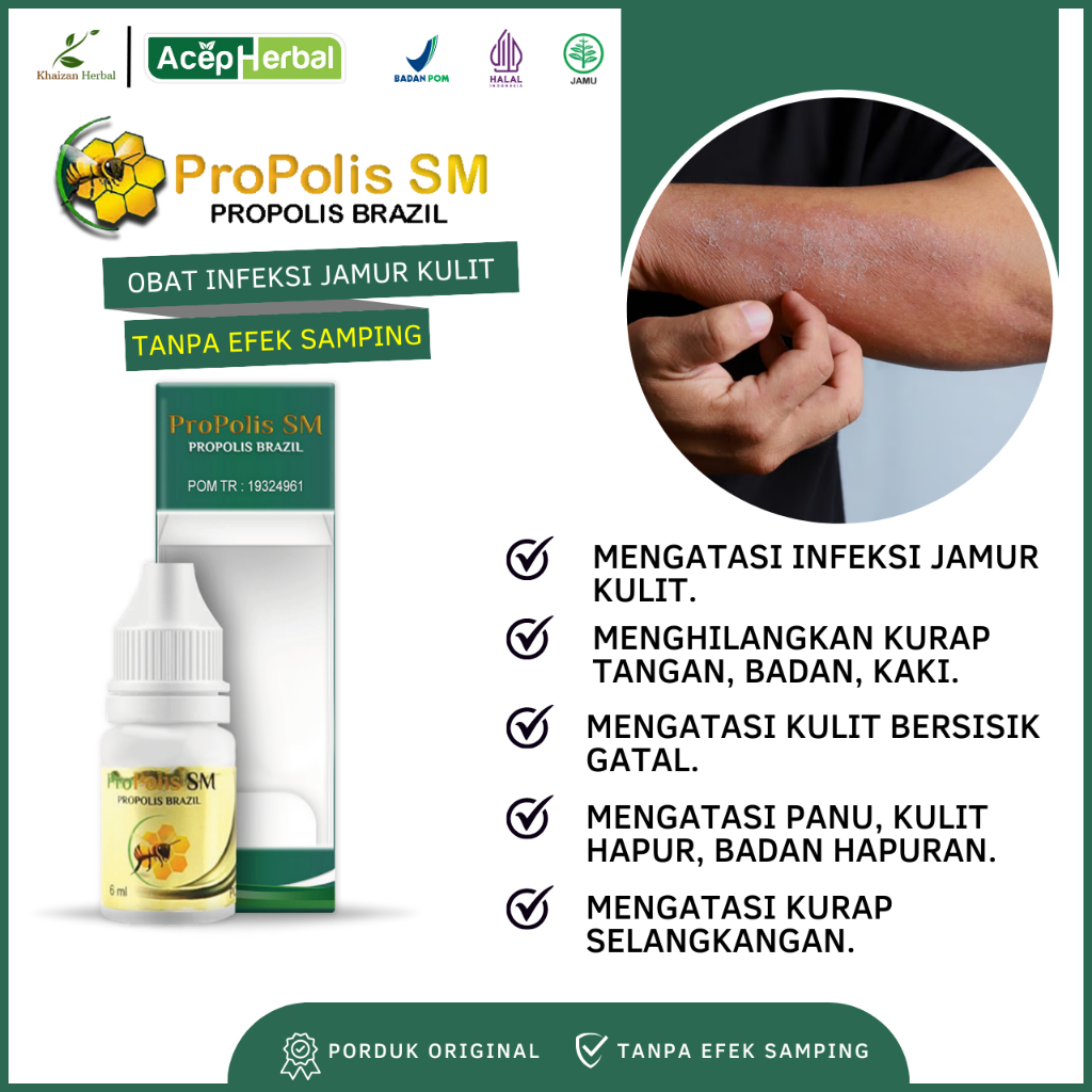Obat Infeksi Jamur Kulit, Menghilangkan Kurap Tangan, Badan, Kaki, Kulit Bersisik Gatal, Kurap, Kuli