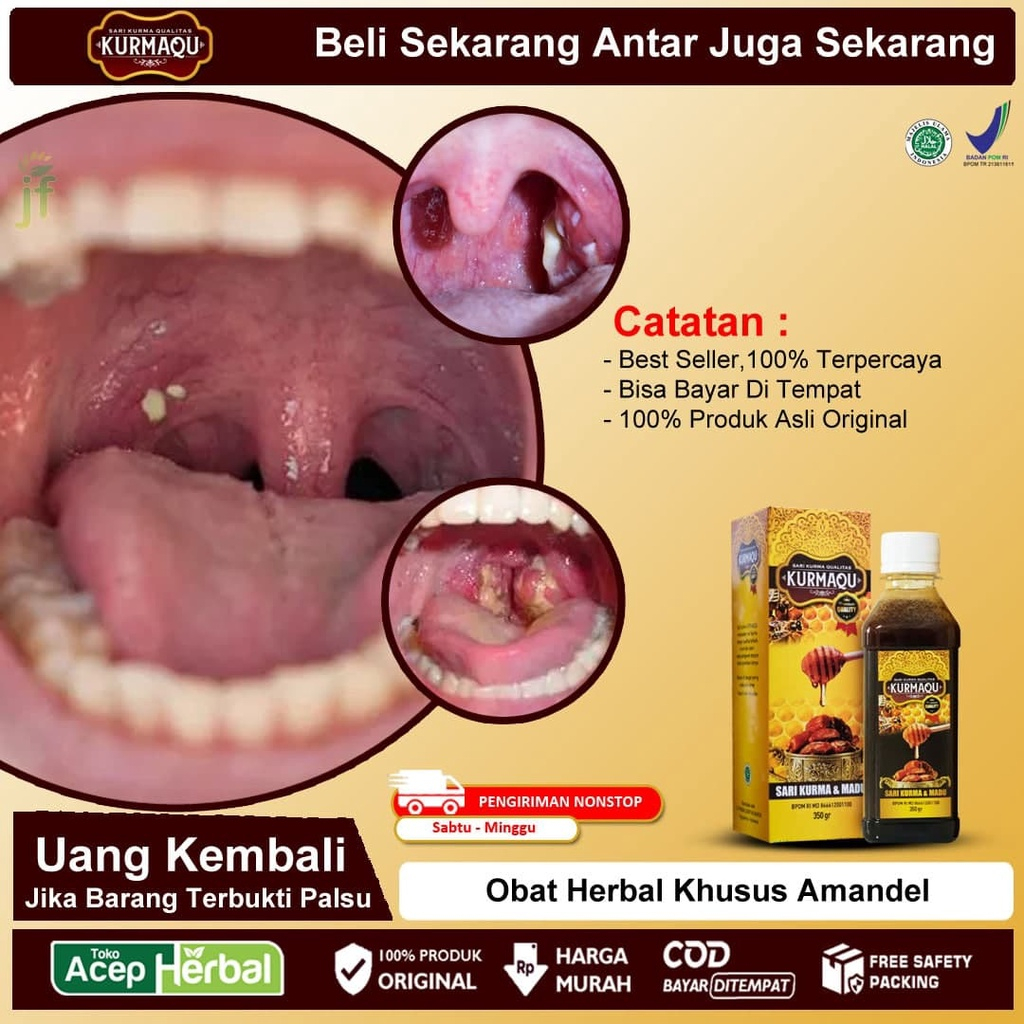 Obat Herbal Khusus Amandel Anak dan Dewasa BPOM, Obat Amandel Bengkak, Obat Radang Amandel, Obat Nyeri Tenggorokan Sulit Menelan,  Sesak Nafas, Gondokan, Asma, Tonsil Akut Dan Kronis, Tumor, Kista, Lipoma, Panas Dalam -  KURMAQU 100% MADU ASLI