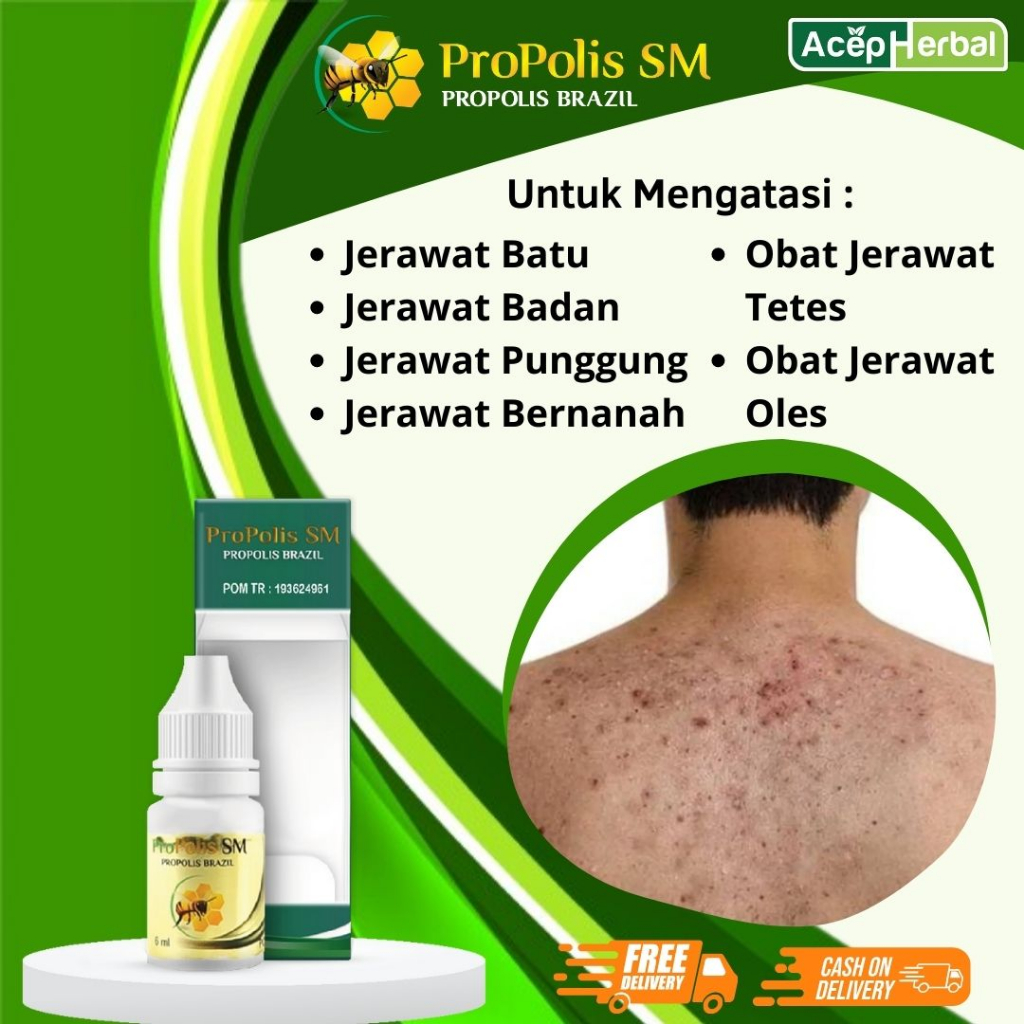 Obat Jerawat Batu - Obat Jerawat , Obat Jerawat Punggung, Obat Jerawat Di Payudara, Obat Jerawat Min