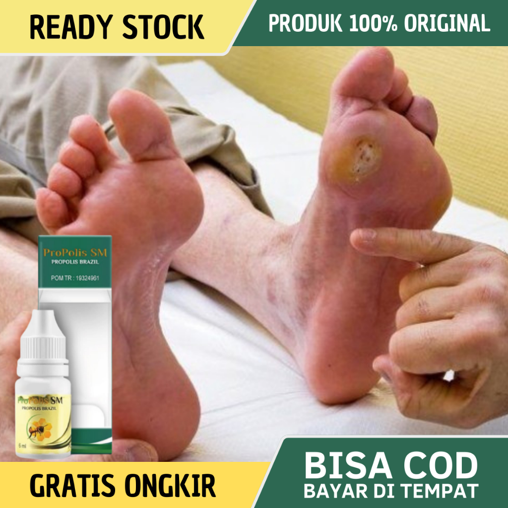 Obat Diabetes, Obat Luka Diabetes, Obat Luka Diabetes Basah Bernanah, Obat Pengering Luka Diabetes B