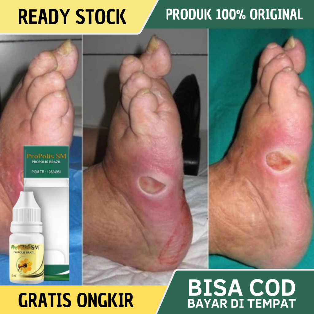 Obat Luka Diabetes, Obat Luka Diabetes Basah Bernanah, Obat Pengering Luka Diabetes Bernanah, Obat P