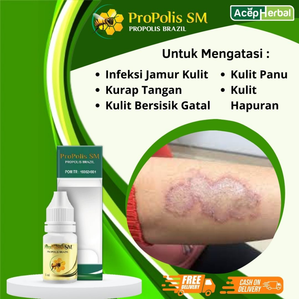 Obat Infeksi Jamur Kulit, Menghilangkan Kurap Tangan, Badan, Kaki, Kulit Bersisik Gatal, Kurap, Kuli
